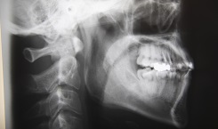 歯を残す保存的療法