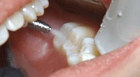 オゾンによる治療の前に歯をしっかりとクリーニングします