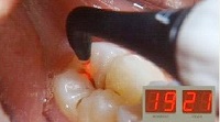 虫歯の状態をダイアグノデント（光学式う蝕検出装置）で調べます。