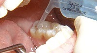 虫歯菌の滅菌後、歯の再石灰化を促進する専用薬剤を塗布します。
