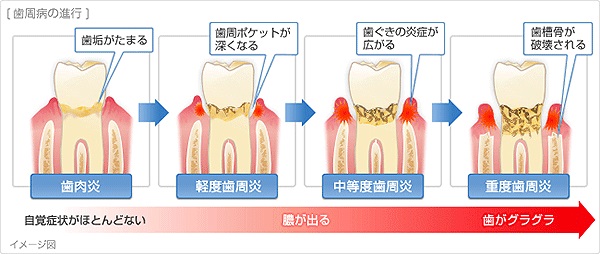 歯周病